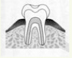 虫歯の進行度:C0