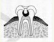 虫歯の進行度:C3