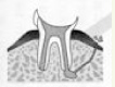 虫歯の進行度:C4
