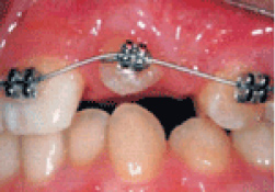 小さな矯正装置で歯牙を誘導しています。
