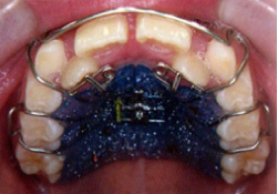 上顎にプレートを入れて、歯を内側から正しい位置に押して移動させていきます。