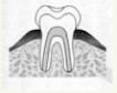 虫歯の進行度:C1