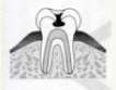 虫歯の進行度:C2
